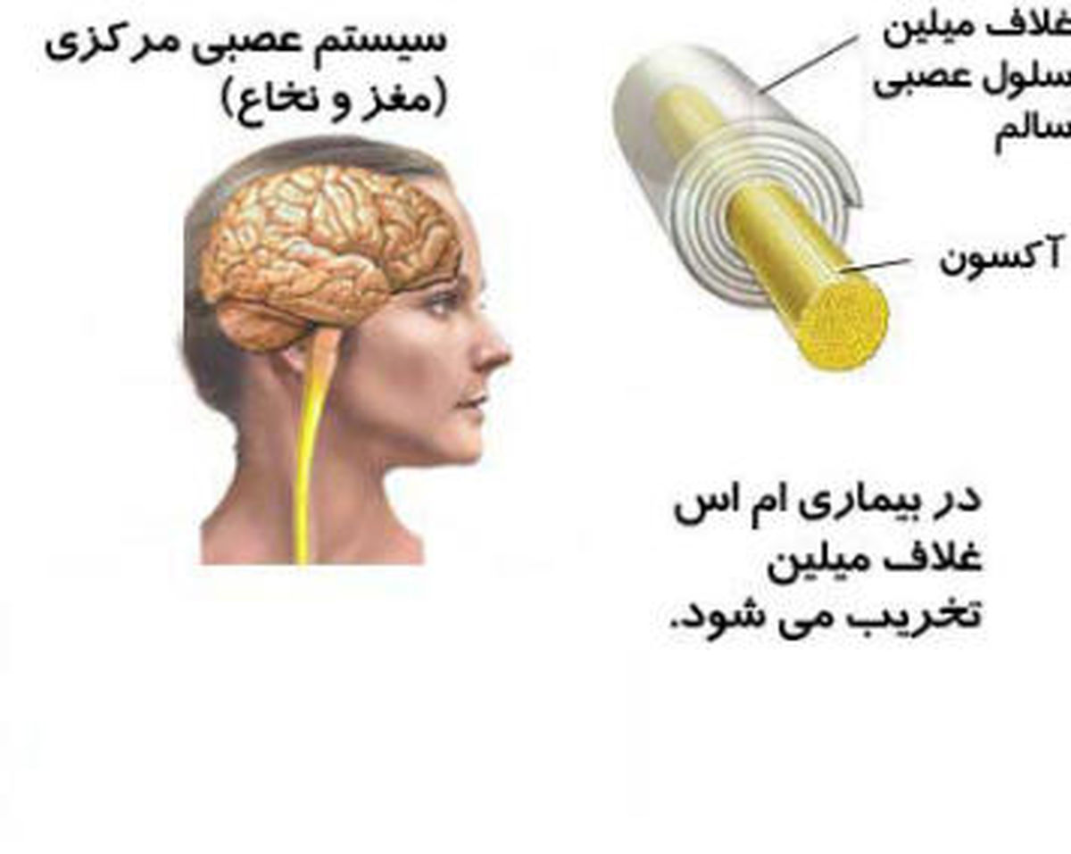 چه کار کنیم تا ام اس(MS) نگیریم؟