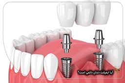 بررسی تخصصی دندانپزشکی دیجیتال: از لمینت و ایمپلنت تا تأثیر ارتودنسی بر گفتار