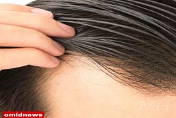 درمان خانگی چرب شدن موی سر + علت و علائم و روش های پیشگیری از آن