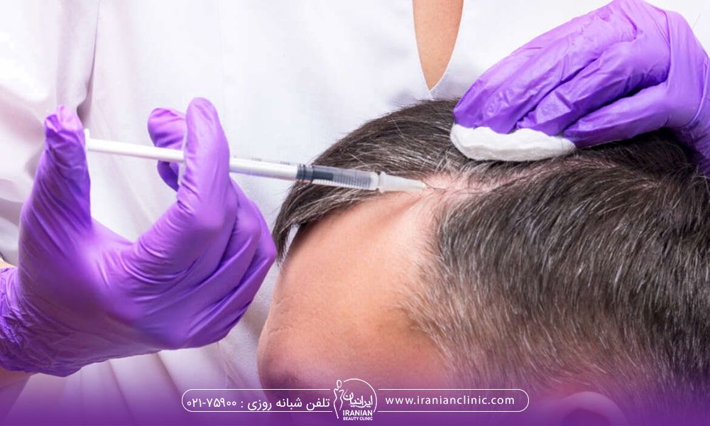 مهم ترین فواید مزوتراپی مو چیست