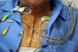 ضرورت حمایت از دارویی که هزینه یک روز آن یک میلیون و ۵۰۰هزار تومان است