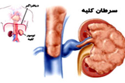 موذی ترین سرطان بدن را بشناسید