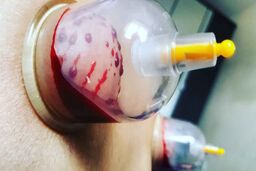 از بهترین روزهای حجامت در پاییز غافل نشید + شرایط و نکات تغذیه ای