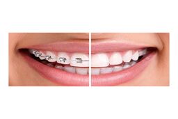  ارتودنسی دندان | نکاتی که قبل و بعد از ارتودنسی باید رعایت کنید