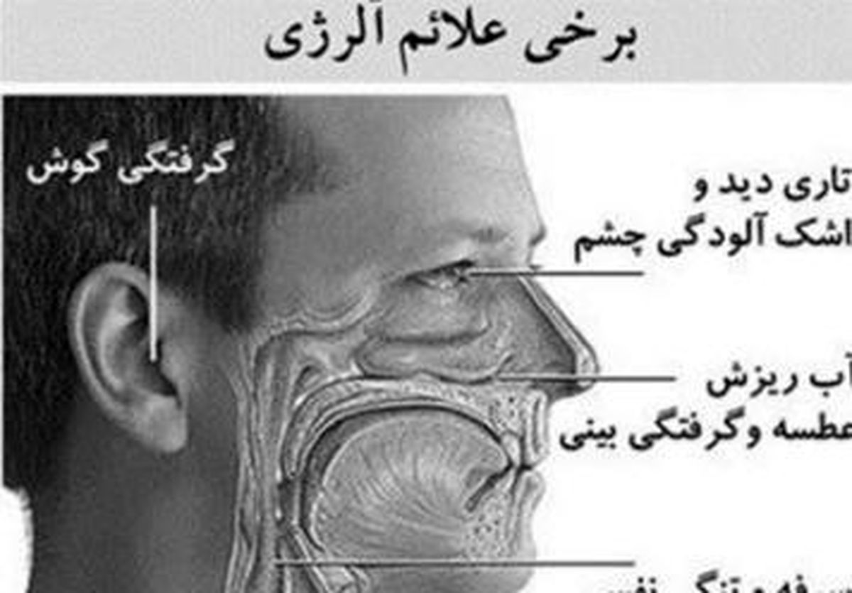 شایع ترین واکنش های آلرژیک را بشناسید + راهکارها