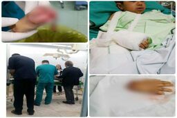 پیوند دست قطع‌شده کودک زلزله‌زده
