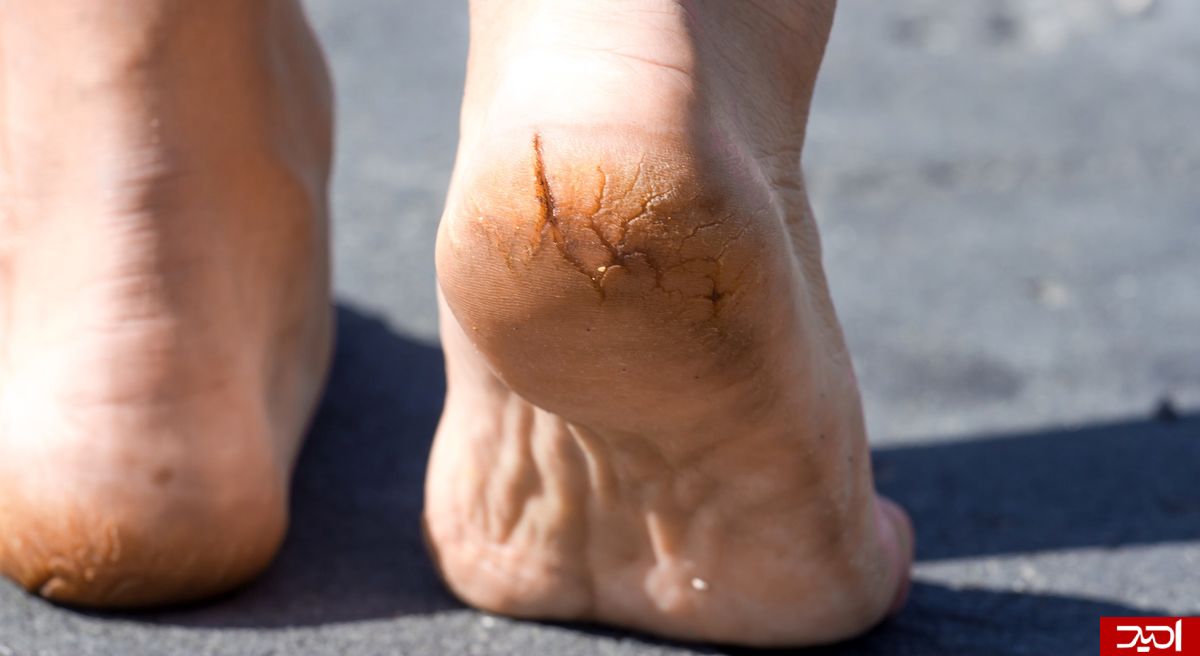 رفع فوری ترک پا با خمیر دندان