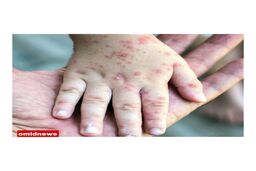 سرخک در کودکان و نوزادان چند روز طول میکشد
