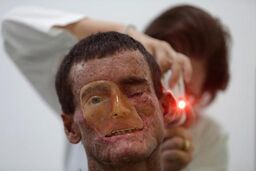 بیماری نادر پوستی در دهکده برزیلی