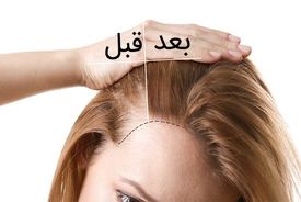 چطور ریزش مو را به سرعت متوقف کنیم؟ 6 درمان خانگی معجزه‌آسا
